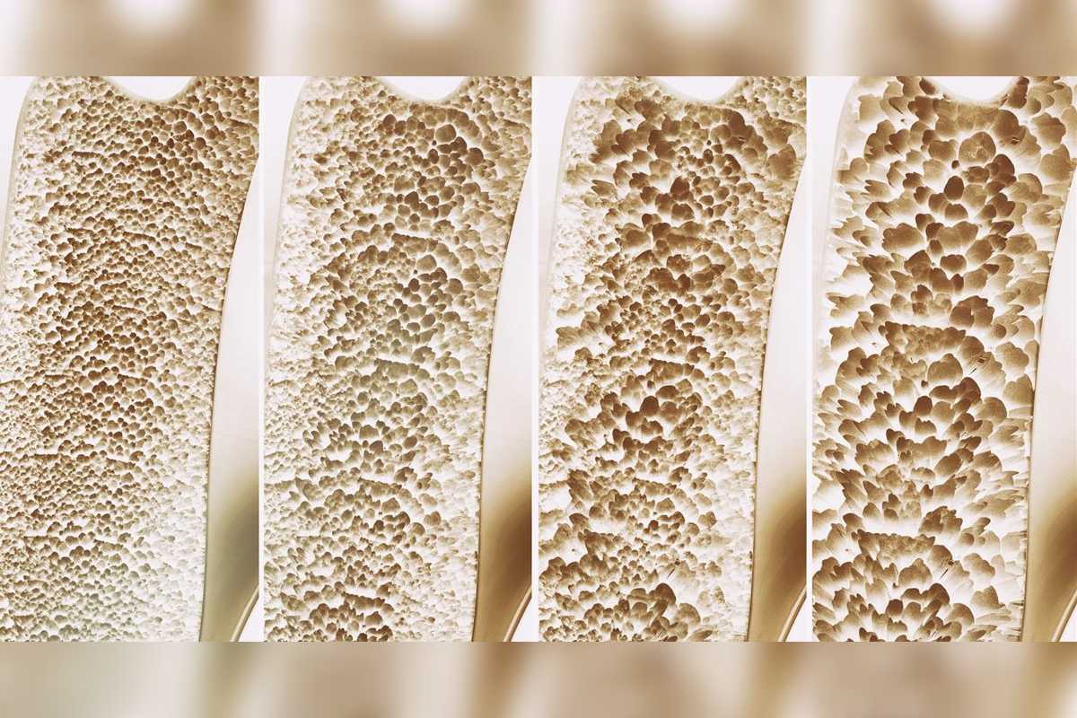 Investigadores de la Universidad Internacional de Florida; encontraron un nuevo tratamiento contra los efectos de la osteoporosis.