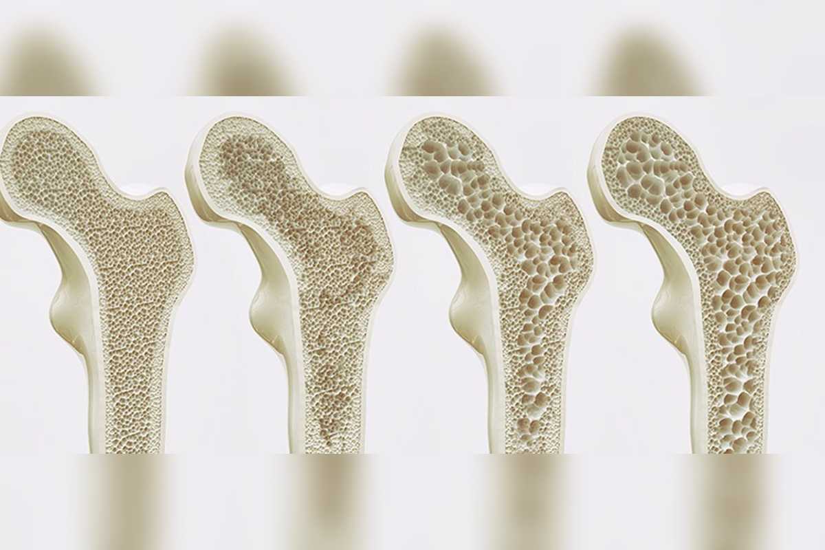 Investigadores de la Universidad Internacional de Florida; encontraron un nuevo tratamiento contra los efectos de la osteoporosis.